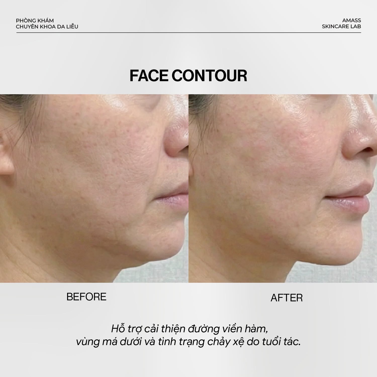 giam-chay-xe-dinh-hinh-duong-vien-ham-face-contour-amass
